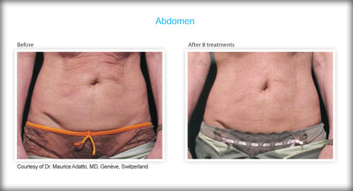 abs before after