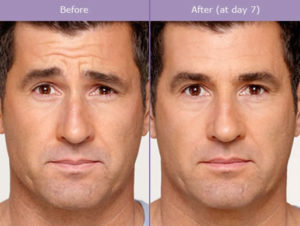 botox-for-men-before-after