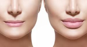 juvederm-lips