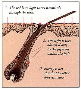 laser_hair_diagram