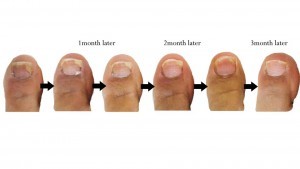 toe-nail-fungus-3-months-post1-300x169