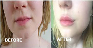 Image result for radiesse cheeks before and after