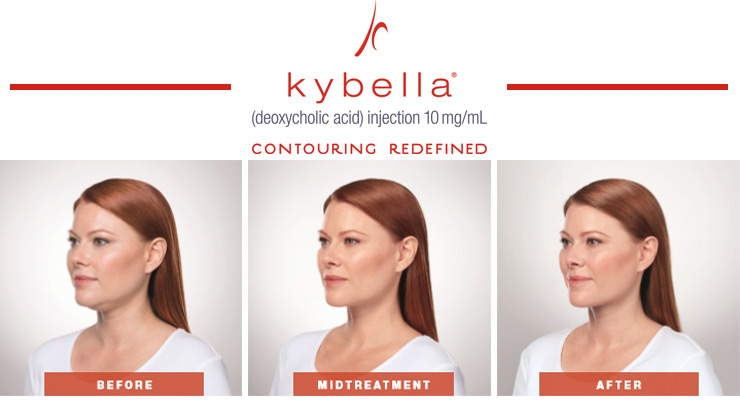 kybella-treatment-banner-1