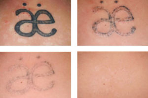 before after laser tattoo removal