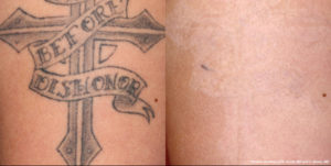 cross laser tattoo removal