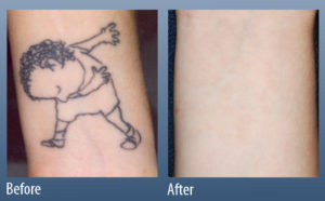 dab laser tattoo removal