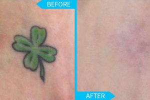 laser tattoo removal shamrock