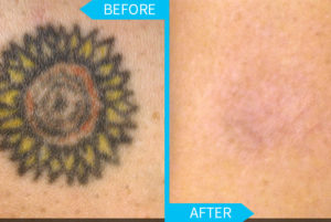 laser tattoo remvoal sunflower 