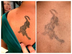 laser tattoo removal jaguar