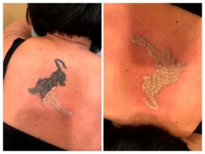 laser tattoo removal after