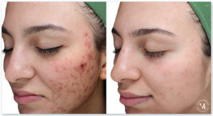 acne peel peel