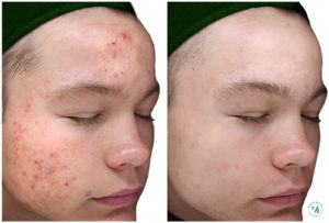 chemical peel for acne