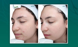 acne chemical peel side by side