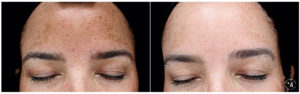 vi peel forehead pigmentation