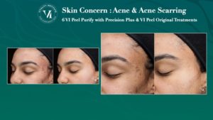 vi peel acne imgage