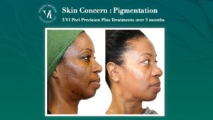 VI Peel Skin Pigmentation darker skin