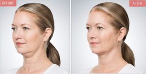 kybella chin