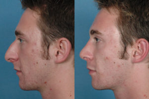 liquid nose job male side