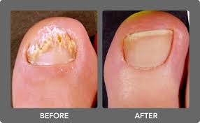 toe nail fungus before & after style medspa
