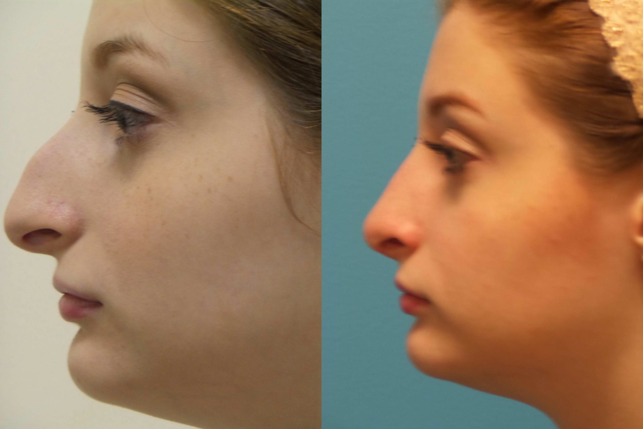 Liquid Nose Job Lift Immediate Results No more nose bumps